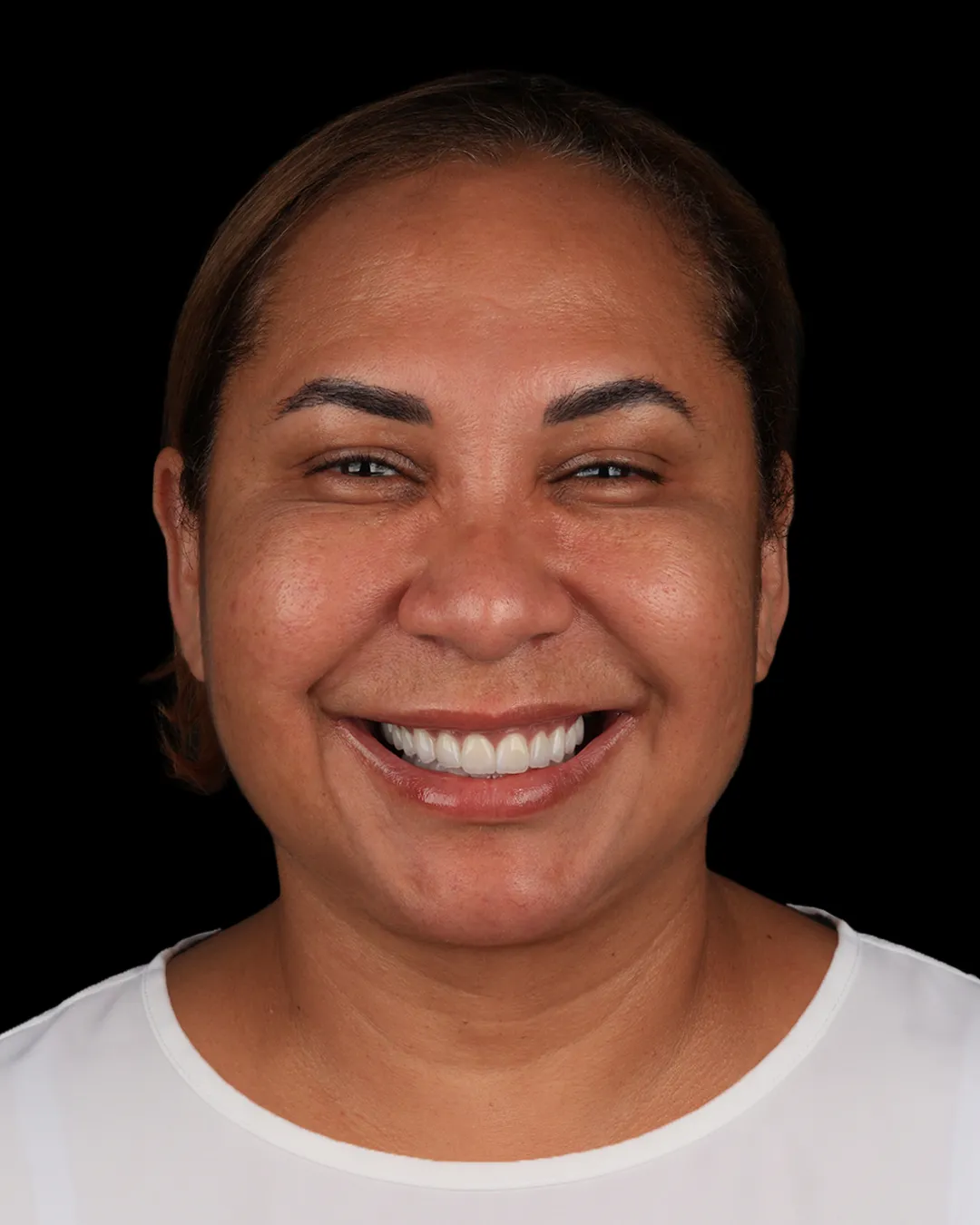 Depois: sorriso com lentes de contato dental — caso 1