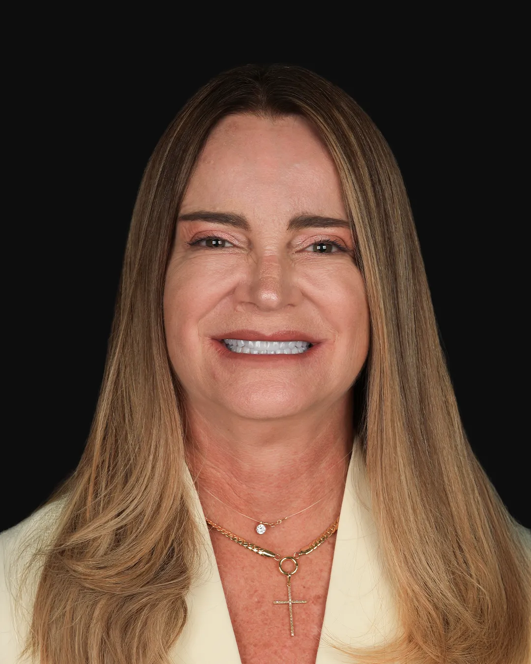 Depois: sorriso com lentes de contato dental — caso 4
