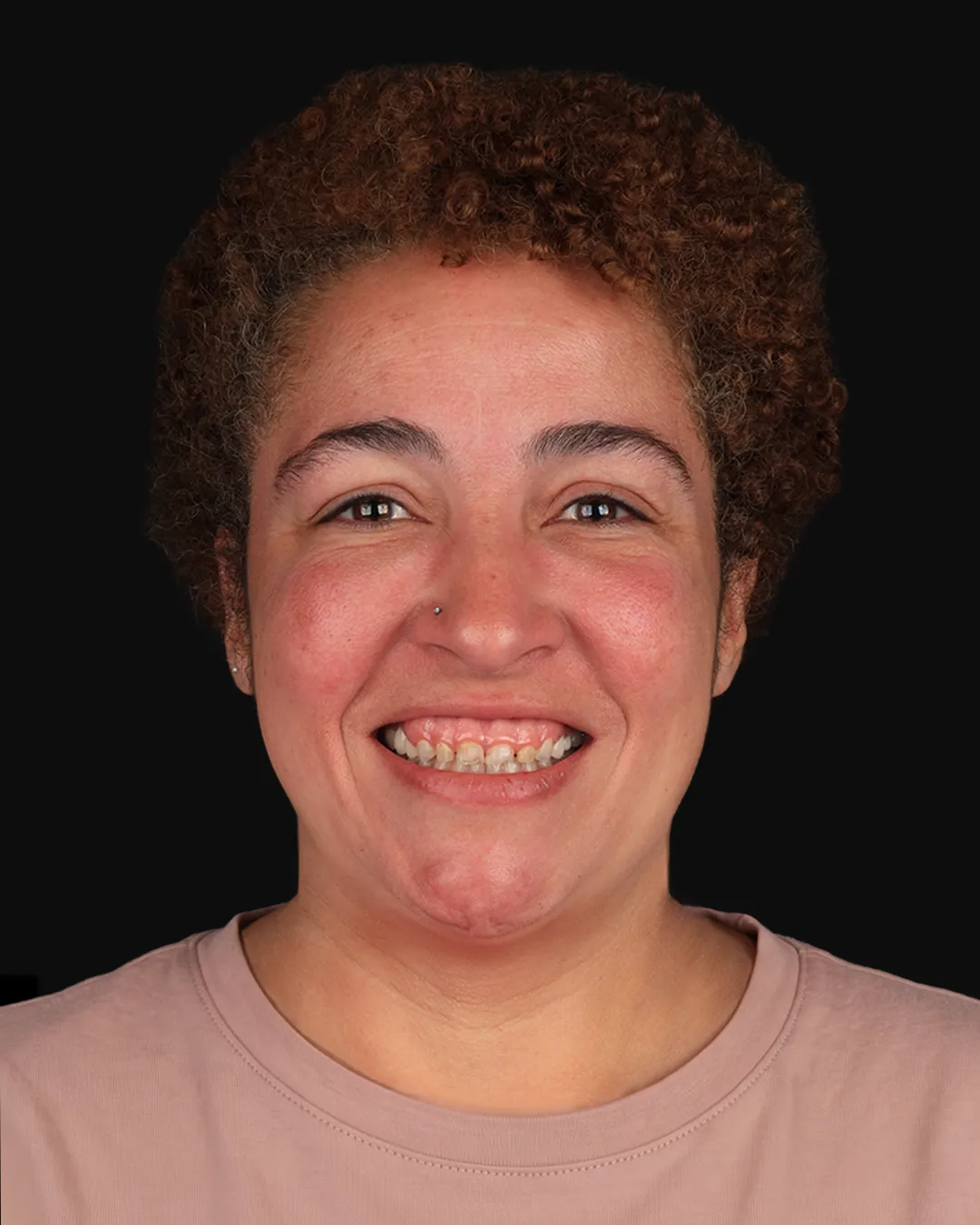 Antes: sorriso da paciente antes das lentes de contato dental