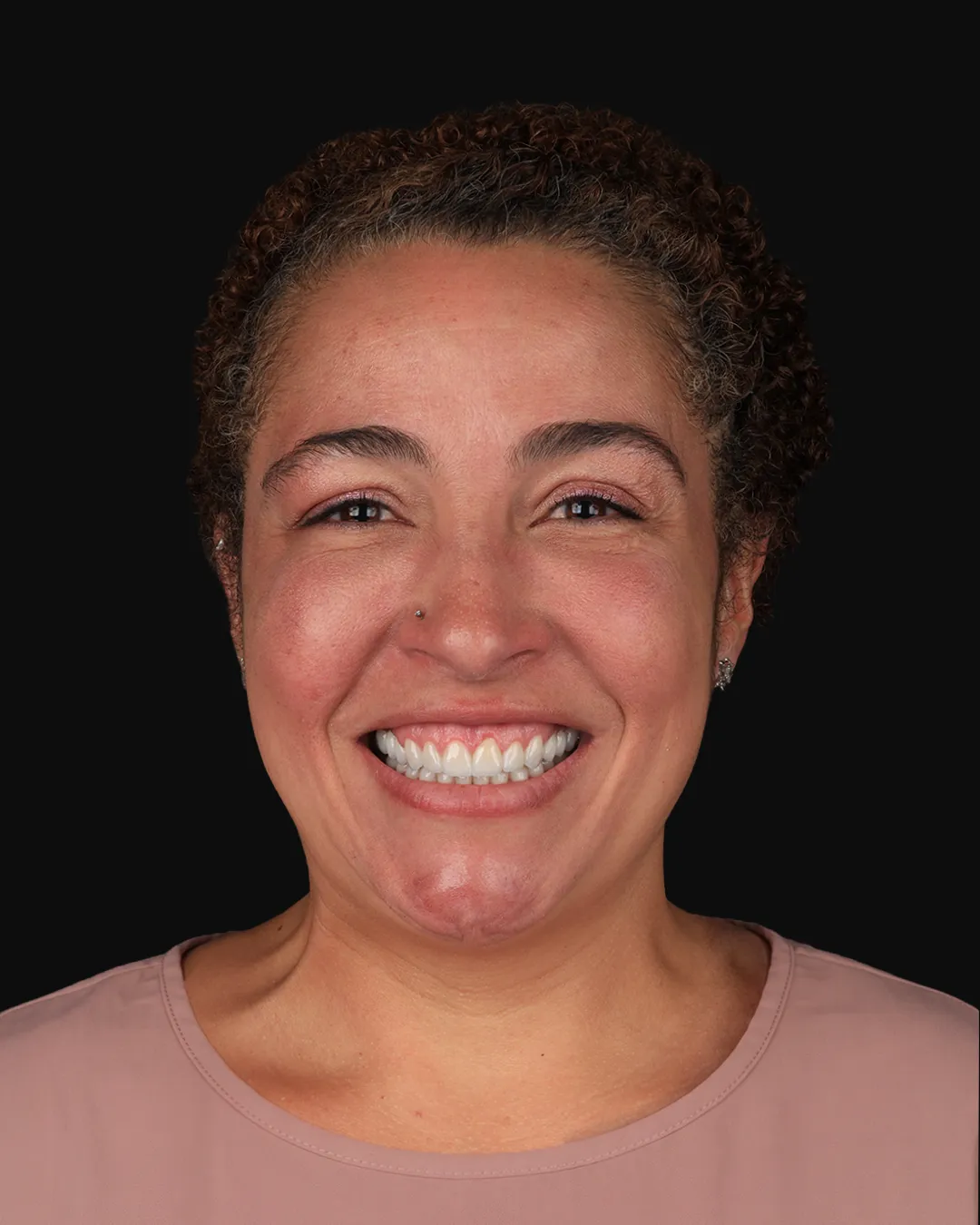 Depois: sorriso com lentes de contato dental, mesmo enquadramento