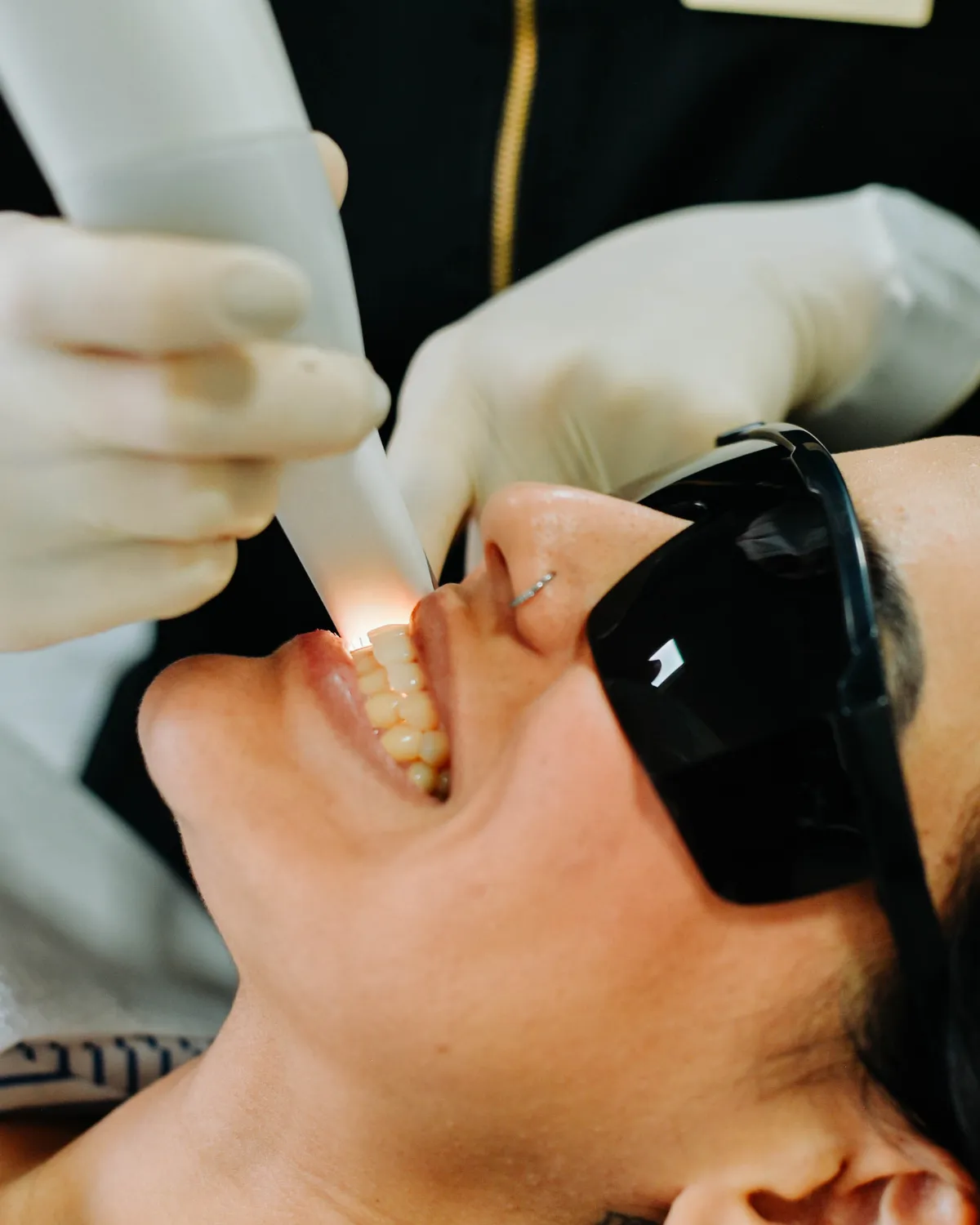 Escaneamento 3D intraoral durante a avaliação para lentes de contato dental